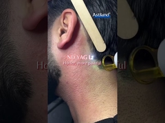 ダイオードレーザー vs ND YAGレーザー どちらを好む?